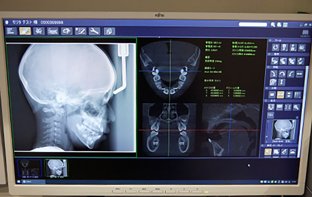 頭部X線規格写真を用いた咬合分析で、精緻な矯正治療を実践