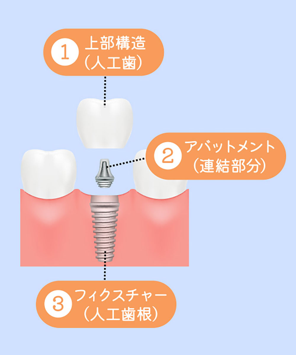 インプラントの構造