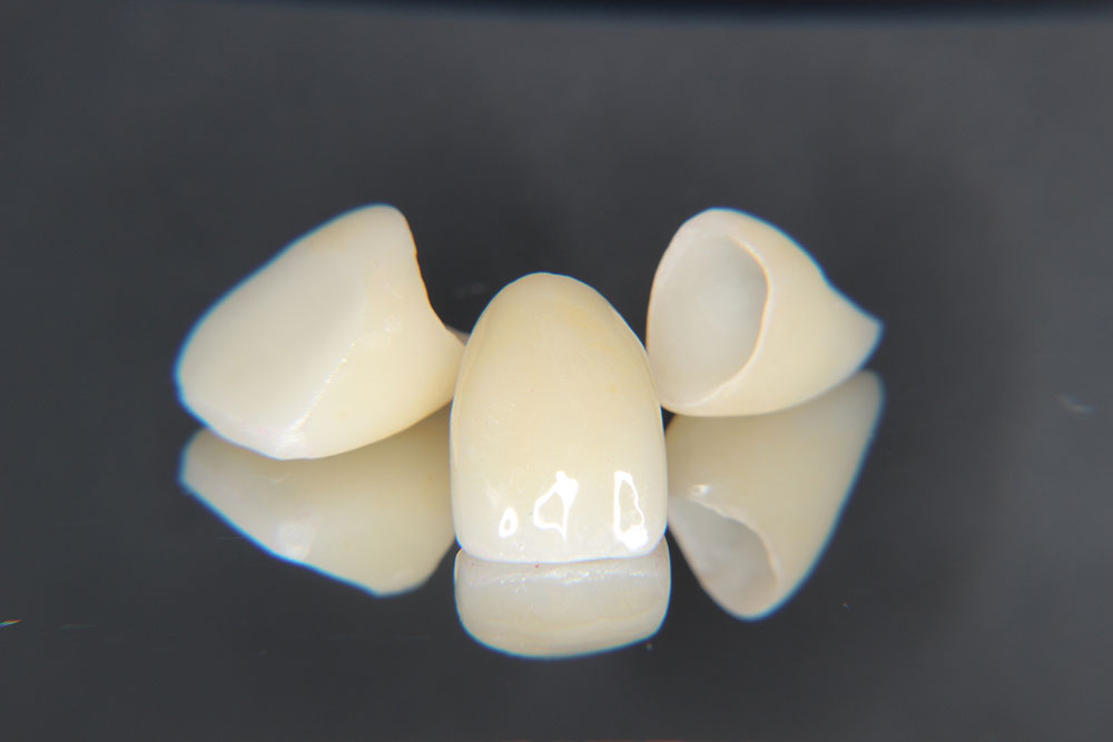 丈夫で自然な見栄えのジルコニア