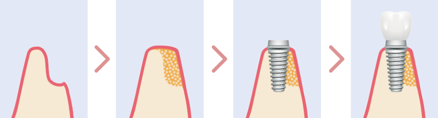 必要箇所の顎の骨を増生するGBR骨増生