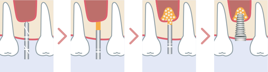 上顎洞の横の歯茎から上顎の骨を増生するサイナスリフト