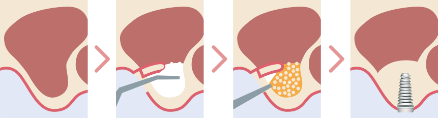 穴を開けて上顎の骨を増生する