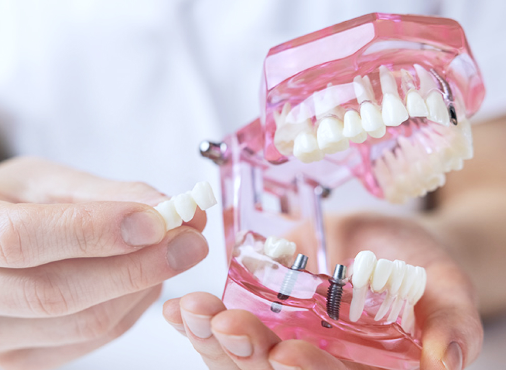 長期的に噛める機能を維持する安定性のある素材選び